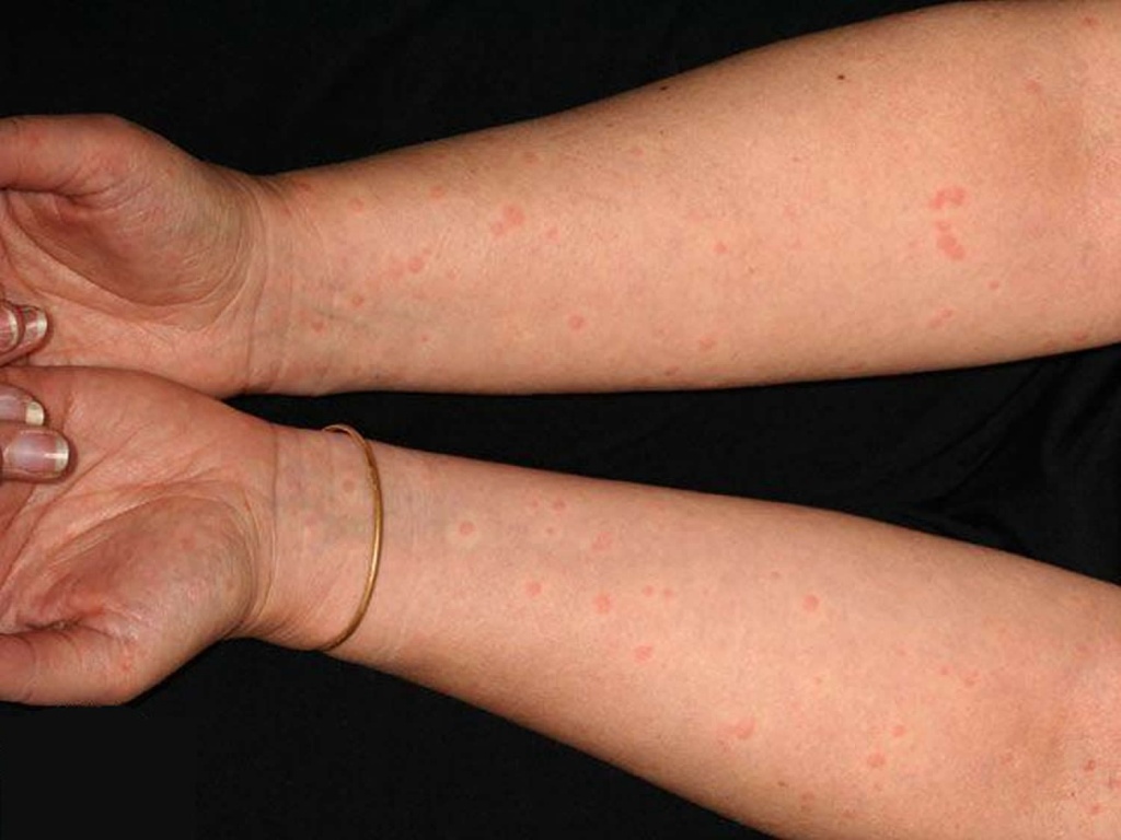 cholinergic-urticaria.jpg