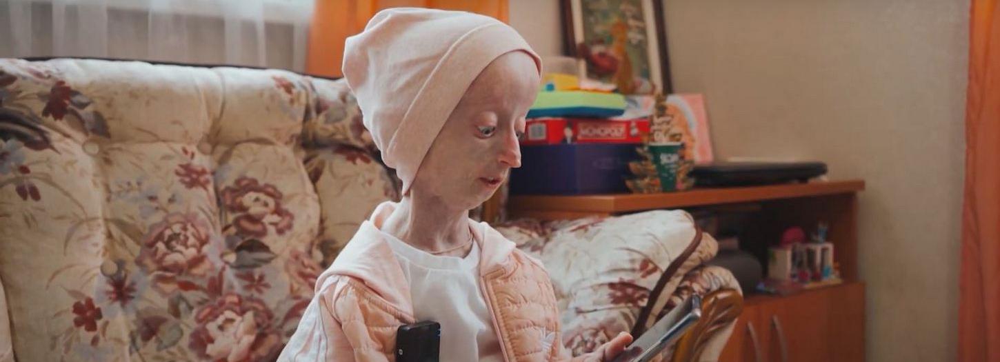 Неунывающий Добби: как живёт быстро стареющая девочка из Новосибирска