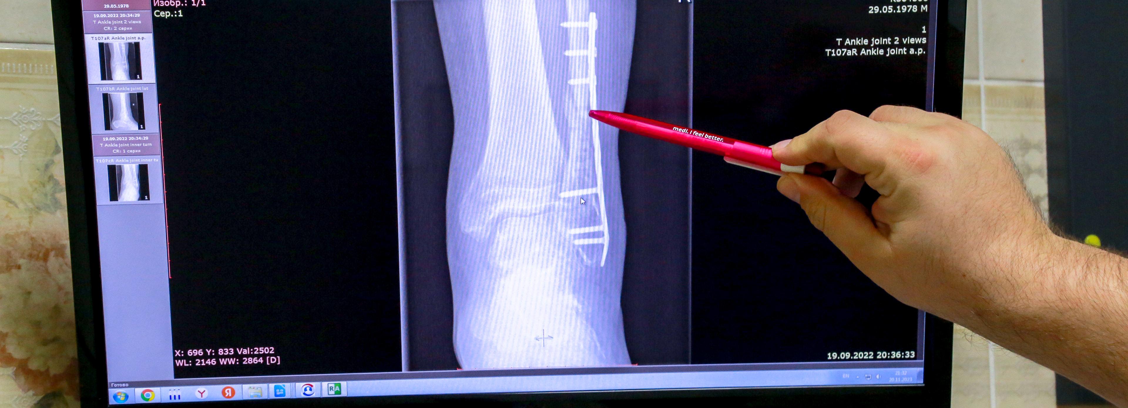 В Новосибирской области выросло количество травм из-за гололедицы