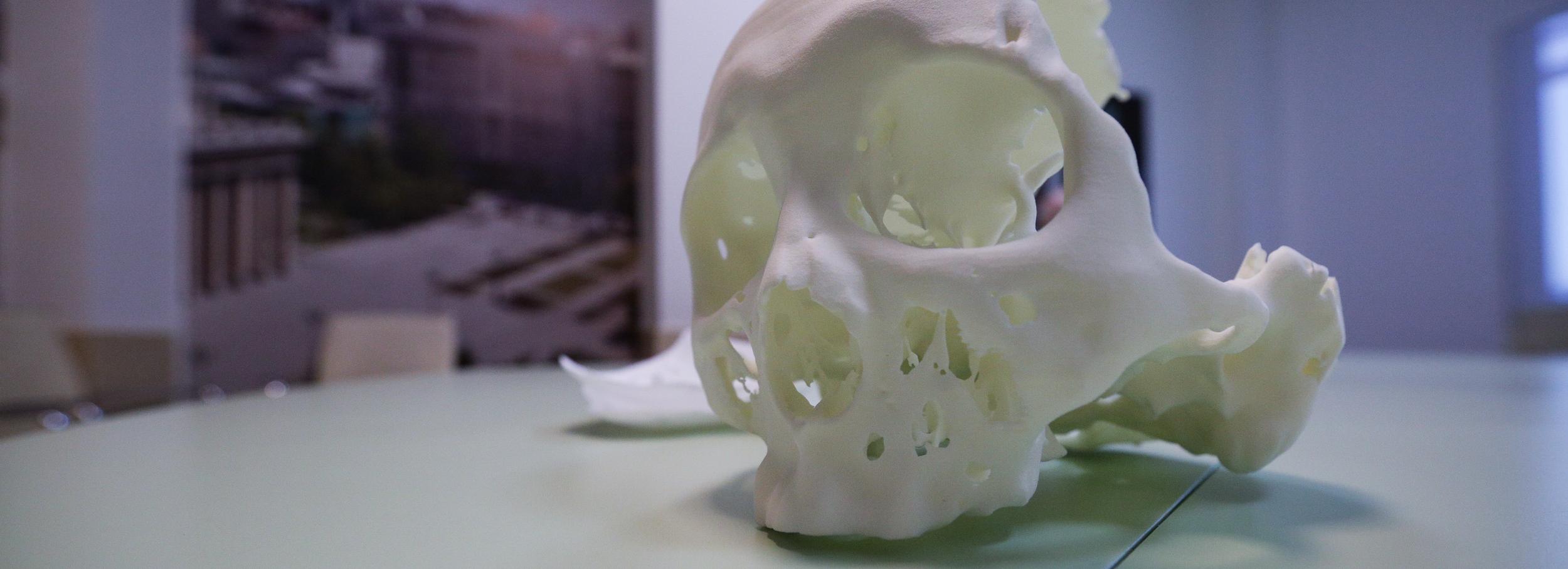 Новосибирцу восстановили череп после удара коробкой передач КАМАЗа