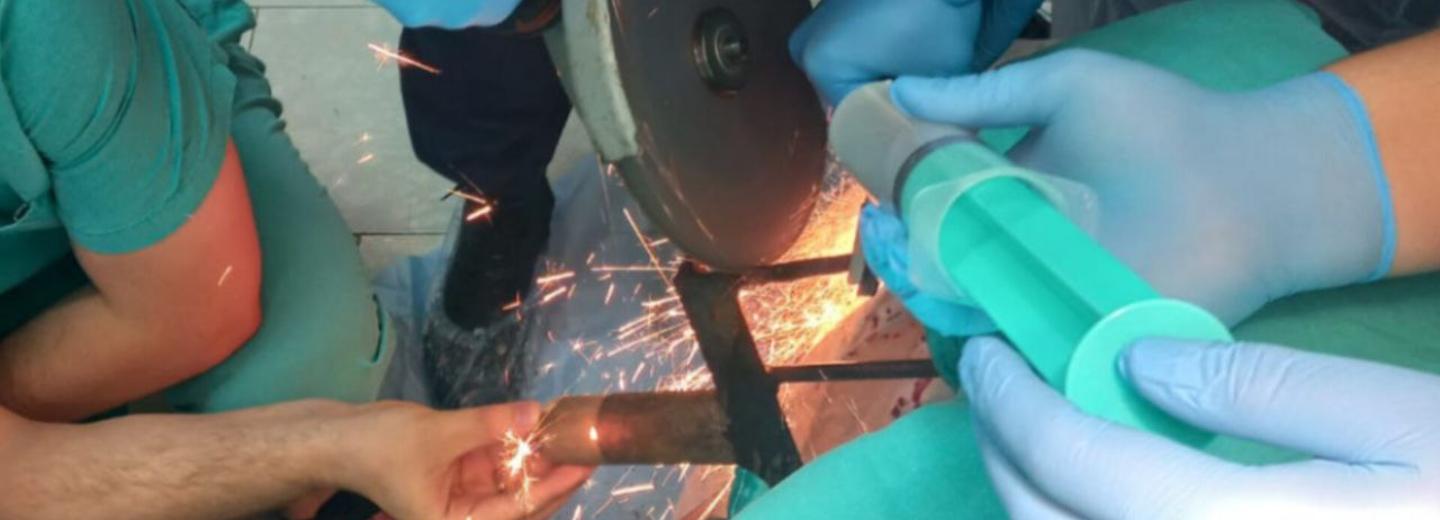 Спасатели помогли хирургам вытащить вилы из головы пациента