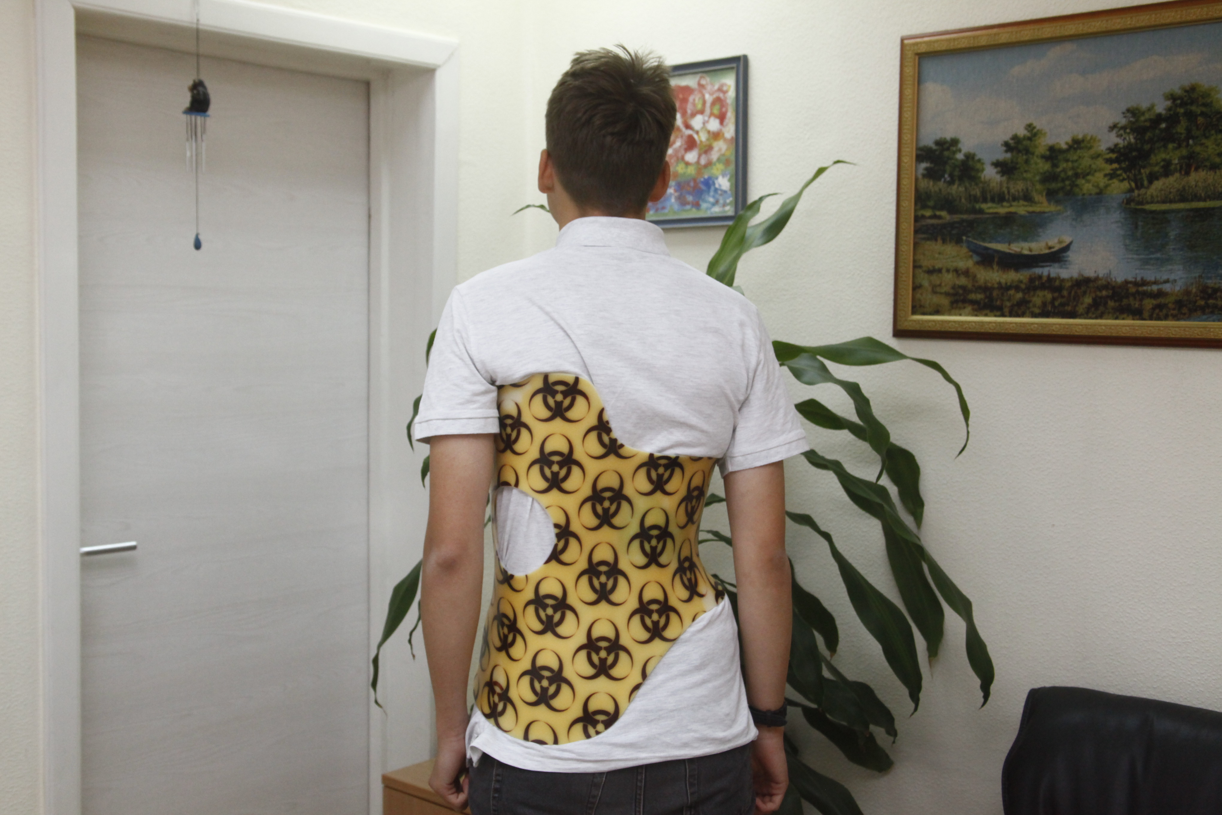 Почему возникает сколиоз — рассказал ортопед из Новосибирска 