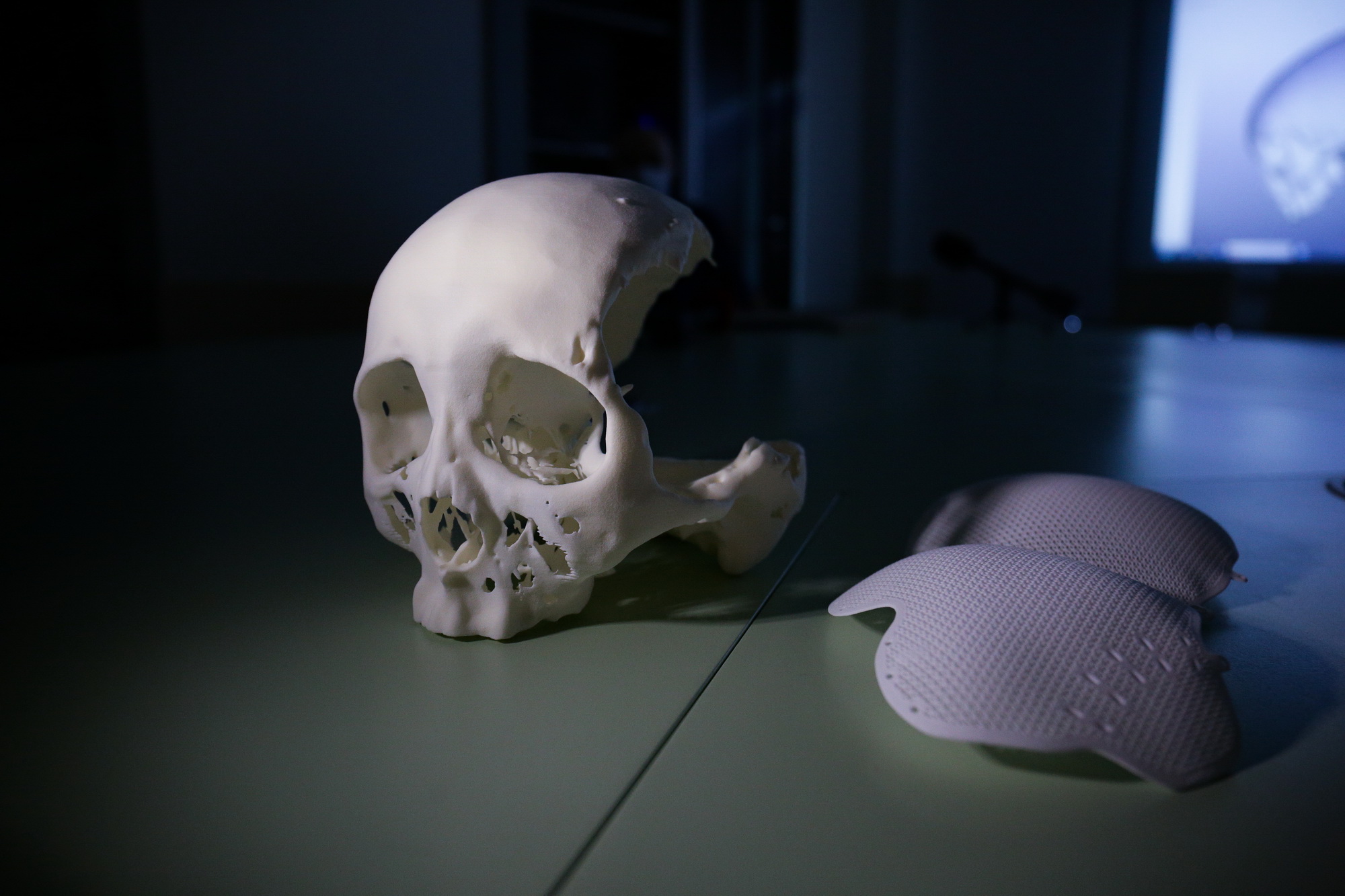 Имплант для восстановления лица создали на 3D-принтере в Новосибирске