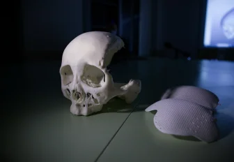 Имплант для восстановления лица создали на 3D-принтере в Новосибирске