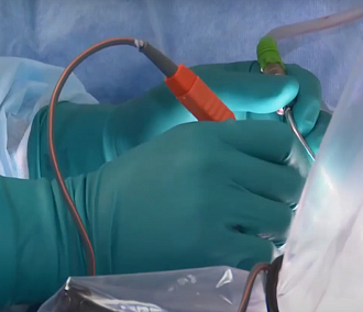 Двухкилограммовую опухоль почки удалили у пациента в Новосибирске